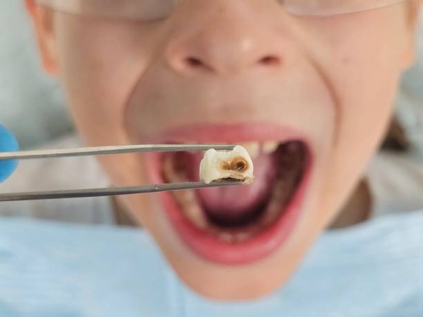 Best Emergency Wisdom Tooth Extraction in Fayetteville, WV