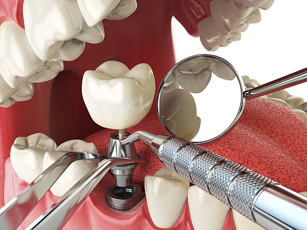 Best Knocked-Out Tooth (Avulsed Tooth) Treatment in Fayetteville, WV
